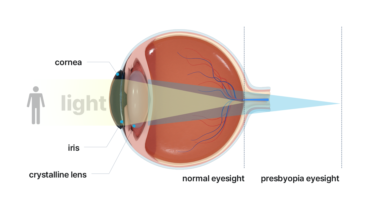 Presbyopia