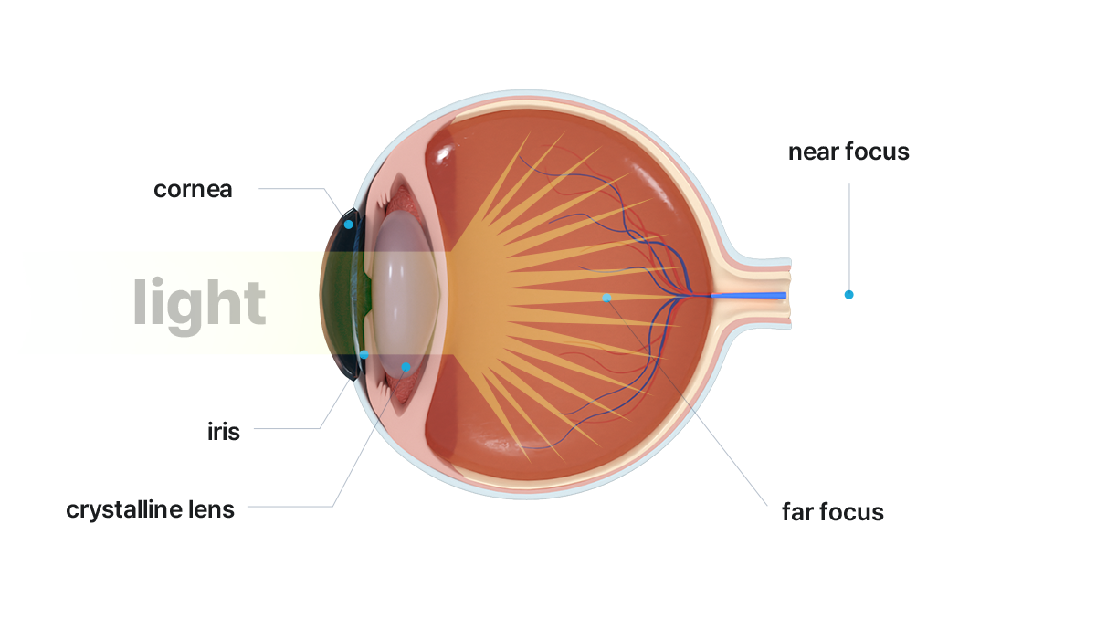 Cataract IOL